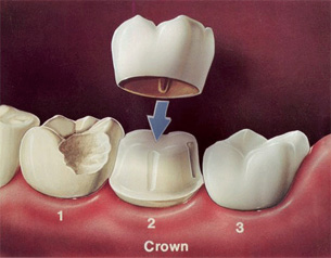 crowns-inner-thumb-1