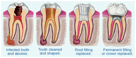 root canal traetment