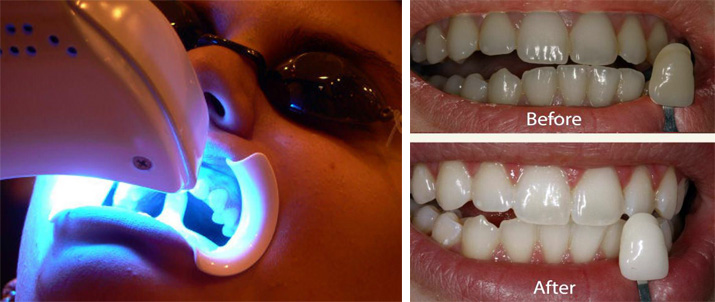 teeth whitening