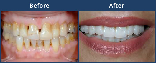 veneers-before-after-thumb