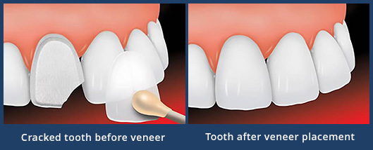 veneers-before-after-thumb1